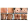 Aparat Vela ShapeIII, Tehnologie RF/IR, Vaccum,  Laser + BipolarRF, Role endermologice, Cavitatie