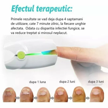 Dispozitiv laser pentru indepartare onicomicoza, ciupercii unghiilor, Alhena®, Tratament ciuperca unghii, alb