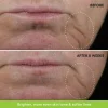 Tretinoin 0.05%, Gel Anti-Rid Menarini A-Ret Anti-Acnee Depigmentant, 20g