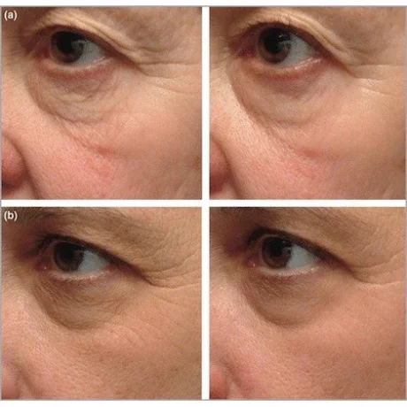 Tretinoin 0.1 %, Gel Anti-Rid Menarini A-Ret Anti-Acnee Depigmentant, 20g
