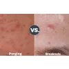 Tretinoin 0.1 %, Gel Anti-Rid Menarini A-Ret Anti-Acnee Depigmentant, 20g