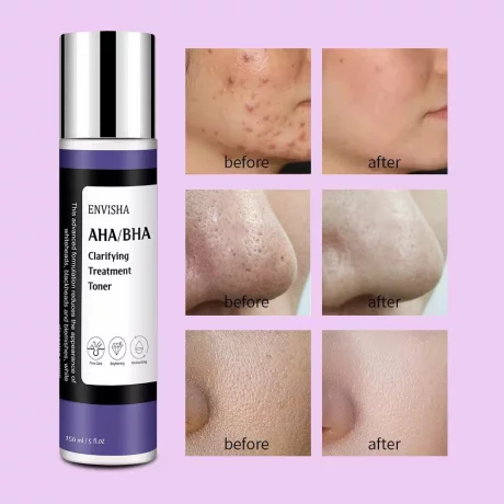 Toner usor exfoliant AHA/BHA, pentru ten acneic cu pori dilatați, minimizează luciul nedorit, menține porii pielii curați