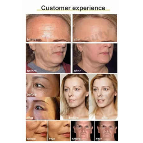 Aparat inteligent de electroliza facia, Tehnologie revolutionara anti aging, RF cu 6 mânere și ecran tactil de 15 inci,  Lifting facial cu microcurent EMS nechirurgical, noninvaziv