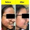 A-ret gel 0,05%, antirid, antiacnee