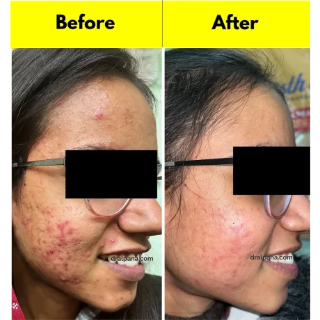 A-ret gel 0,05%, antirid, antiacnee