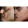A-ret gel 0,05%, antirid, antiacnee
