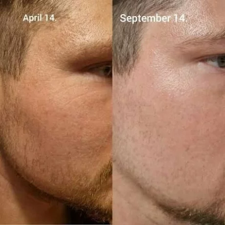 A-ret gel 0,1%, retinoid, antirid, antiacnee, depigmentant, 20g