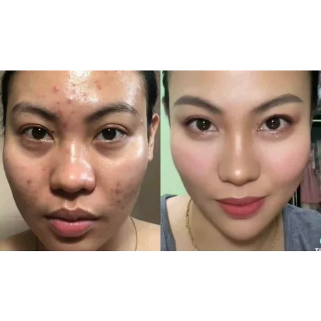 Tretinoin 0.05%, Gel Anti-Rid Menarini A-Ret Anti-Acnee Depigmentant, 20g